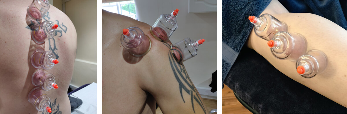 Cupping treatments